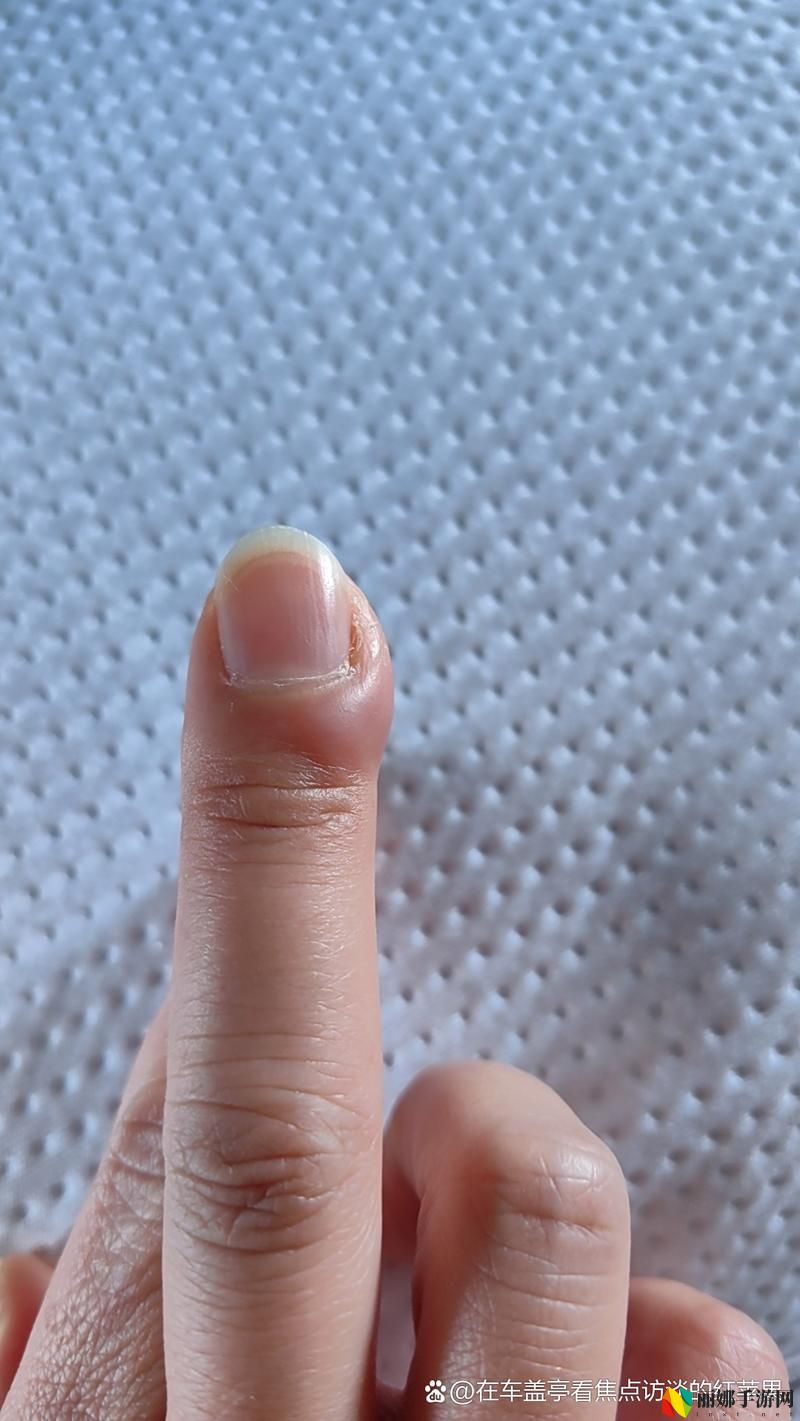 粗大的蘑菇头刮得又红又肿怎么办