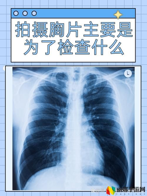 100%胸片曝光率软件